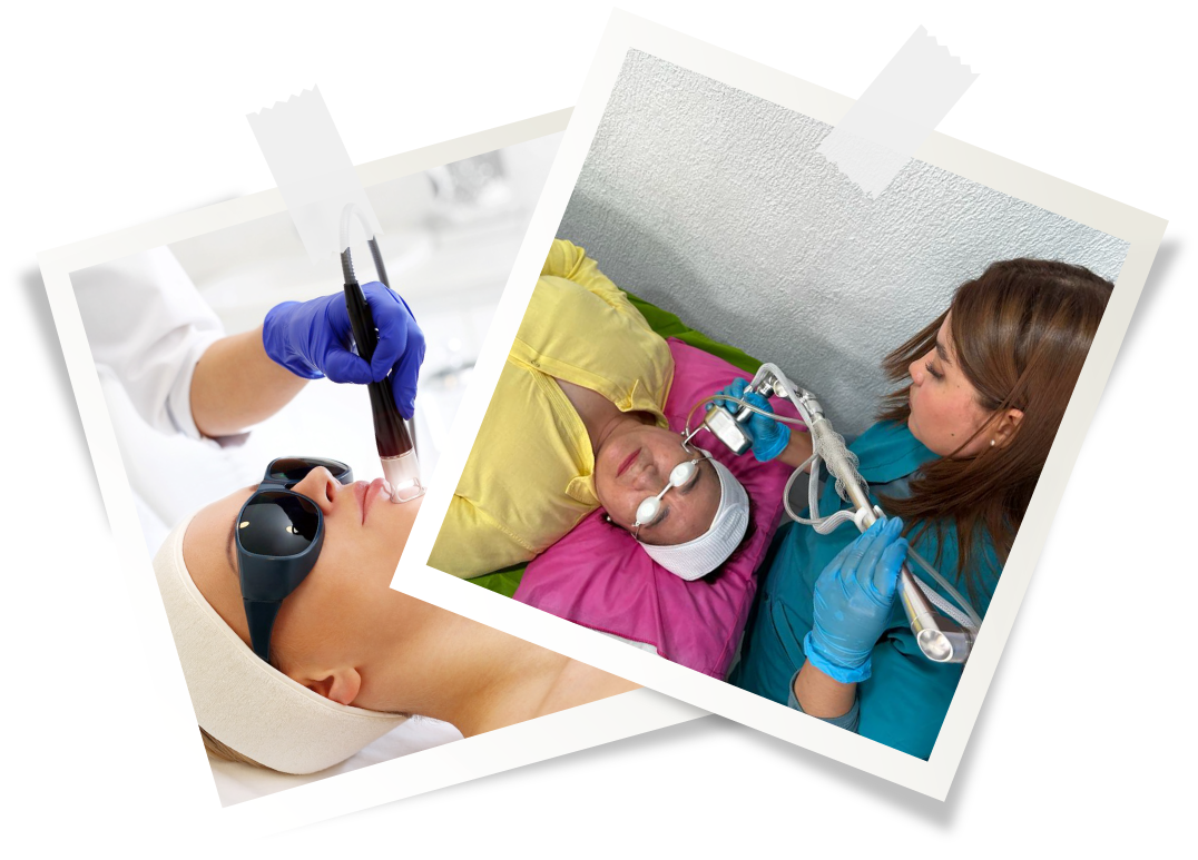 Tratamiento facial laser